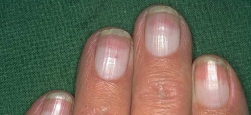11 проблем с ногтями, которые служат симптомами заболеваний — не пропустите их