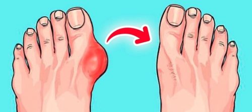 Косточка с больших пальцев стоп уходит. 5 упражнений, которые я делала